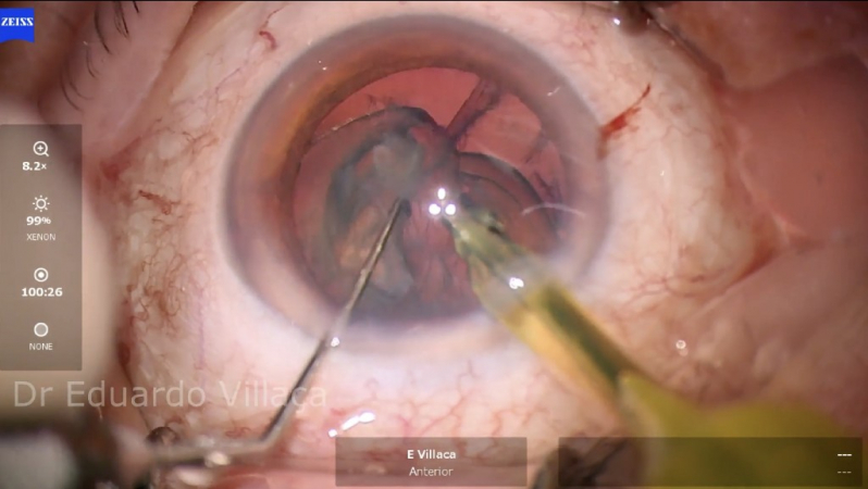 Telefone de Facectomia com Implante de Lente Intraocular São Paulo - Facectomia com Implante de Lente Intra Ocular com Facoemulsificação