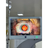 agendamento de facoemulsificação com implante de lente intraocular barra funda