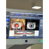 agendamento de facoemulsificação com implante de lente Vila Regente Feijó