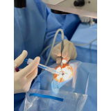 cirurgia a laser de catarata Osasco
