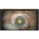 cirurgia catarata com implante de lente marcar Cajamar