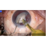 cirurgia catarata com implante de lente Pompéia