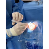 cirurgia catarata facoemulsificação Ibirapuera