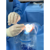cirurgia catarata laser marcar Vila Vessoni