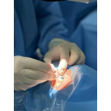 cirurgia de catarata a laser agendar Vila Dila