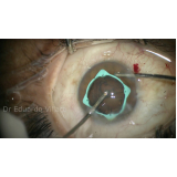 cirurgia de catarata com colocação de lente Heliópolis