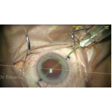 cirurgia de catarata com implante de lente multifocal Santa Cecília
