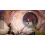 cirurgia de catarata com lente dentro do olho Alto da Mooca