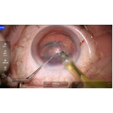 cirurgia de catarata com lente importada Pompéia