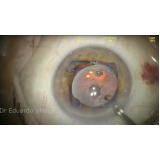 cirurgia de catarata com lente intra ocular marcar bras leme