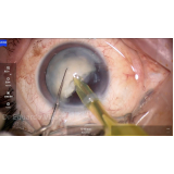 cirurgia de catarata com lente intra ocular Sé