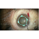 cirurgia de catarata com lente multifocal barra funda
