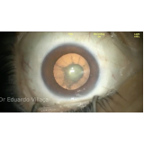 cirurgia de catarata e correção de miopia marcar Lençóis Paulista
