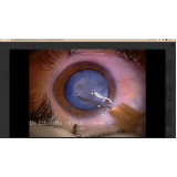 cirurgia de catarata lente intraocular marcar Vila Romana