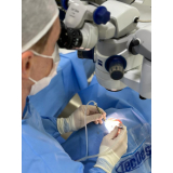 cirurgia de catarata no olho clínica Vila Cordeiro