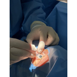 cirurgia de catarata por facoemulsificação imirin