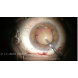 cirurgia de descolamento de retina com gás Vila Leopoldina