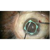 cirurgia de implante de lente no olho ultramarino