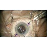 cirurgia de lente no olho para catarata agendar Itaquaquecetuba