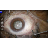 cirurgia para colocação de lente intraocular Campo Grande