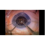 cirurgia para colocar lente intraocular agendar Igarapava