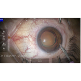 cirurgia para implantar lente no olho Cajamar