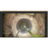 Cirurgia de Catarata com Lente Dentro do Olho