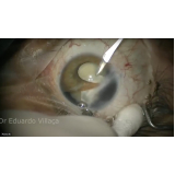 Cirurgia de Implante de Lente no Olho