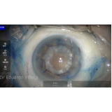 clínica especializada em facectomia com lente intraocular Artur Alvim