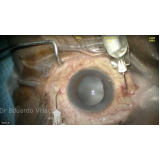 clínica que faz cirurgia de lente intraocular Lauzane Paulista