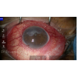 clínica que faz cirurgia de lente no olho para catarata ARUJÁ