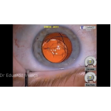 clínica que faz cirurgia para implantar lente no olho Vila Leopoldina