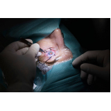 clínica que faz operação de catarata com lente Mogi Guaçu