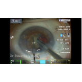 facectomia com implante de lente intra ocular com facoemulsificação Ermelino Matarazzo