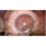 facectomia com implante de lente intraocular agendar Alto de Pinheiros