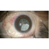 facectomia com implante de lente intraocular Vargem Grande Paulista