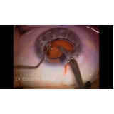 facectomia com implante de lente marcar Embu