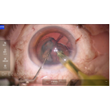 facectomia com lente intraocular marcar Zona Sul