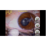Facectomia com Implante de Lente Intra Ocular com Facoemulsificação