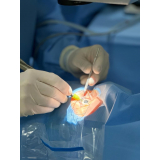 facoemulsificação do cristalino com implantação de lente intraocular marcar ultramarino