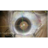 onde agendar cirurgia para implantar lente no olho Indianópolis