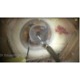 onde fazer cirurgia catarata com implante de lente Ibirapuera