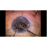 onde fazer cirurgia de catarata lente intraocular Santa Cruz