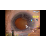 onde marcar cirurgia de catarata com implante de lente multifocal Vila Romana