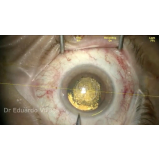 onde marcar cirurgia de catarata com lente multifocal Vila Carmosina