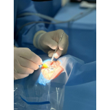 operação de catarata com implante de lente Jardins